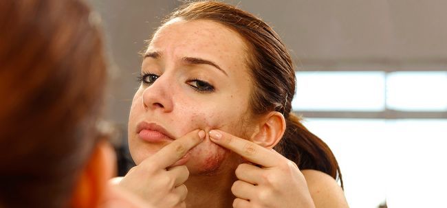 5 traitements de l'acné vulgaris simple mais très efficace Photo
