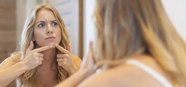 5 façons simples pour se débarrasser de l'acné menton Photo