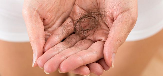 L'alopécie traitement de perte de cheveux Photo