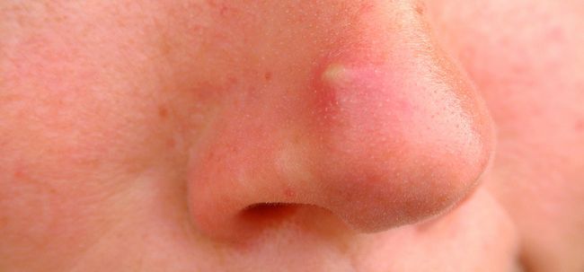 L'acné kystique - quel est-il et comment y remédier? Photo