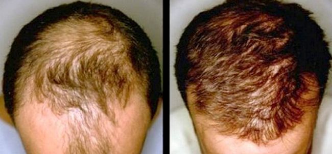 La croissance des cheveux contre la calvitie - causes et solutions Photo