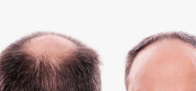 Comment aborder la perte de cheveux en plaques? Photo