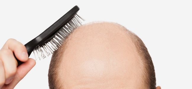 Comment traiter la calvitie partielle pour perte de cheveux? Photo