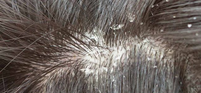Top 10 des remèdes maison pour guérir champignon de cheveux Photo