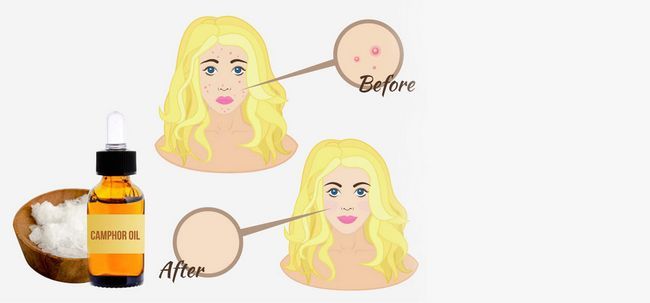 2 façons efficaces d'utiliser l'huile de camphre pour traiter l'acné Photo