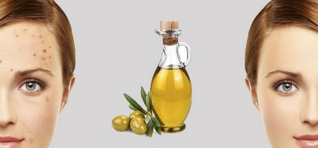 7 façons Facile à utiliser l'huile d'olive pour se débarrasser des cicatrices d'acné Photo