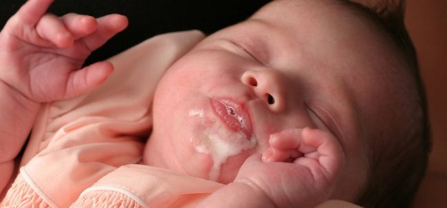 7 Les symptômes de l'allergie au lait chez les bébés Photo