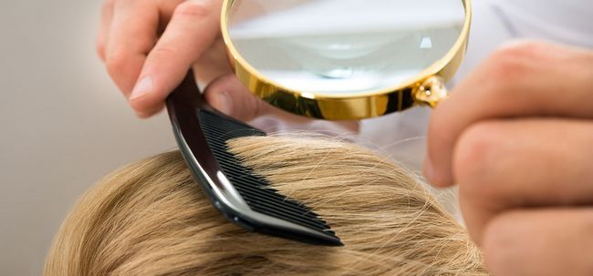 10 Les effets secondaires de la greffe de cheveux, vous devriez être au courant Photo