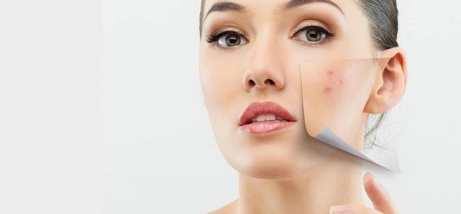 10 Des remèdes simples pour traiter l'acné de la peau sèche Photo