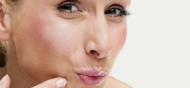 9 façons de prendre soin de boutons sur bouche et des lèvres Photo