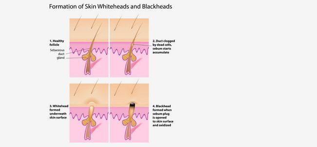 Points noirs et blancs: début de l'acné Photo