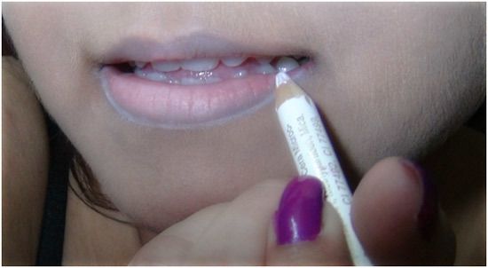 gonflées inférieurs lèvres des causes