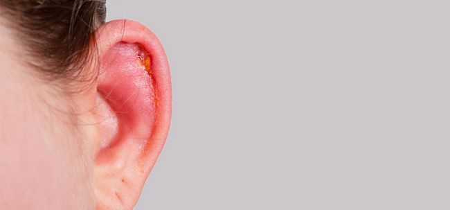 Top 10 des remèdes efficaces à domicile pour les infections de l'oreille Photo