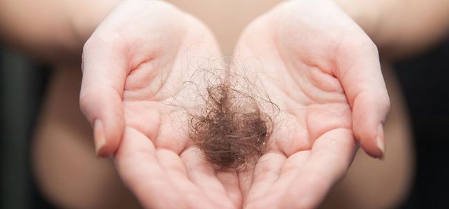 Top 5 des remèdes permanents pour traiter la perte de cheveux Photo